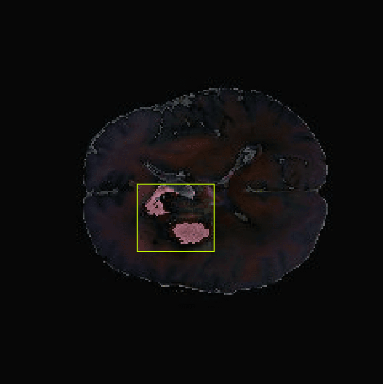 MRI scan with a highlighted area indicating a brain tumor.